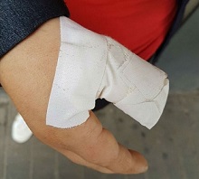 Para robarle el celular, le cortaron uno dedo